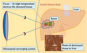 HIFU how does it work